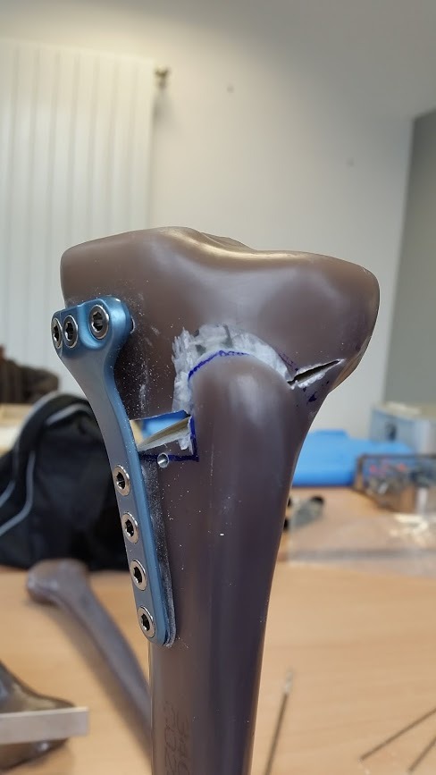 Osteotomia, come allontanare la protesi di ginocchio